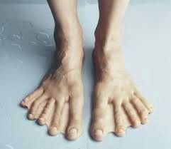 webbed feet human.jpg
